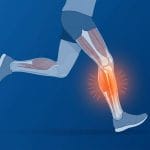 Shin Splints Itu Apa Sebenarnya? Penjelasan Lengkap dari Fisioterapis