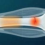 Shin Splints vs Stress Fracture Tibia: Bagaimana Cara Membedakannya?