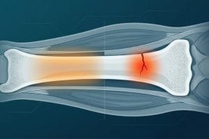 Shin Splints vs Stress Fracture Tibia: Bagaimana Cara Membedakannya?